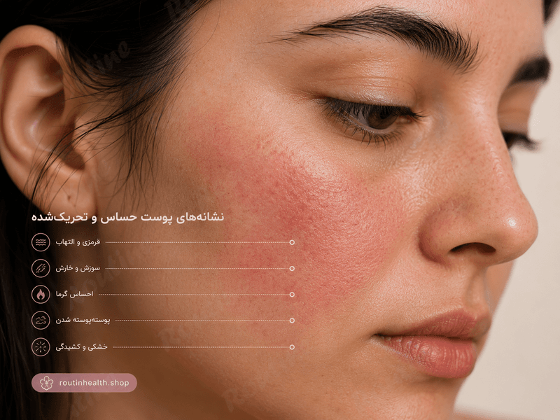قرمزی و التهاب پوست حساس بعد از استفاده از ضد آفتاب نامناسب